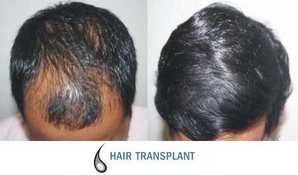 Hair Transplant is in Fashion for Bald Celebrities  Ak Clinics